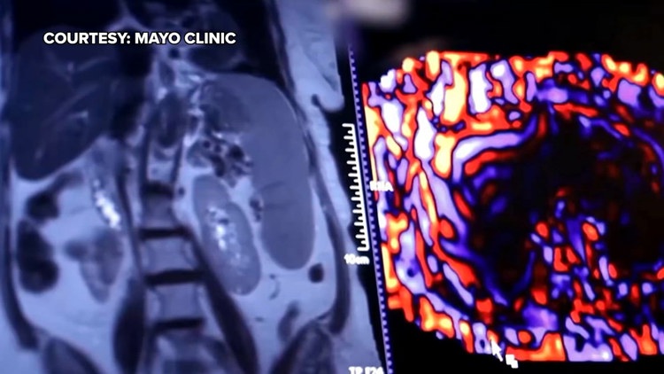 Healthy SA: Battling liver cancer, a disease which often has no symptoms early on — KENS 5 (San Antonio), St. Augustine Health news